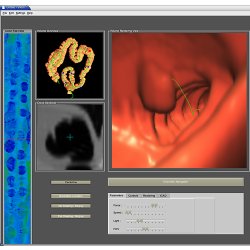 screenshot of a user interface for virtual colonoscopy