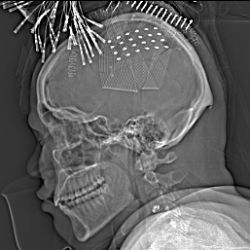 X-ray showing electrodes on patient's brain
