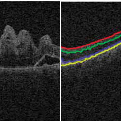 retinal image segmentation