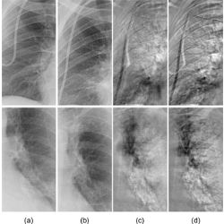comparison of rib-suppressed temporal-subtraction images