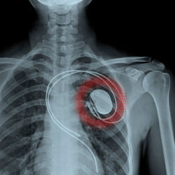 X-ray image of implanted medical device