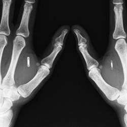An X-ray showing two of the implants in Tim Shank's hands.