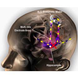 Electrodes wired into the brain's hippocampus can bypass a damaged memory region (the red X) and restore or reinforce memories.