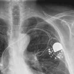 X-ray of a patient with an implanted pacemaker.